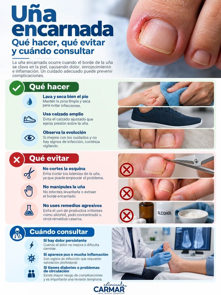 Infografía sobre qué hacer, qué evitar y cuándo consultar por una uña encarnada